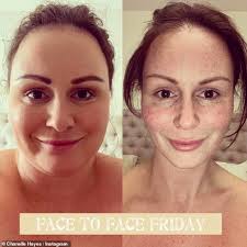 Signs Of Malnutrition After Gastric Bypass