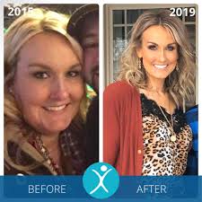 Hair Loss From Malnutrition Is It Reversible